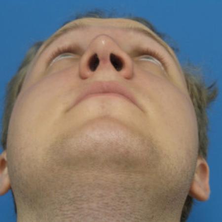 After image 4 Case #102296 - 19 year old  -  Open Septo-Rhinoplasty with Inferior Turbinectomies  -  3 months post-op
