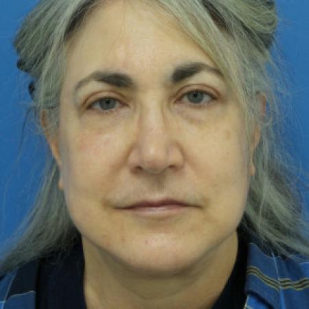 After image 1 Case #102216 - 66 year old   -  Facelift/Upper Blepharoplasty  -  3 1/2 months post-op