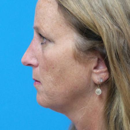 After image 3 Case #102276 - 55 year old - This patient presented with exposed bone after sustaining an open nasal bone fracture.