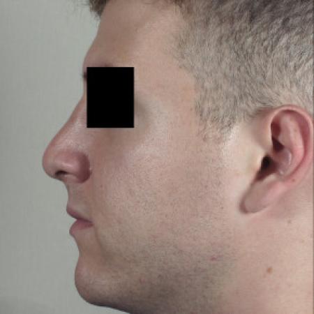 After image 2 Case #103126 - Rhinoplasty Patient 75