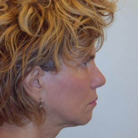 After image 3 Case #101576 - Facelift