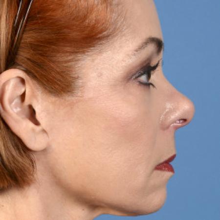 After image 3 Case #102136 - Facelift - 60-year-old woman