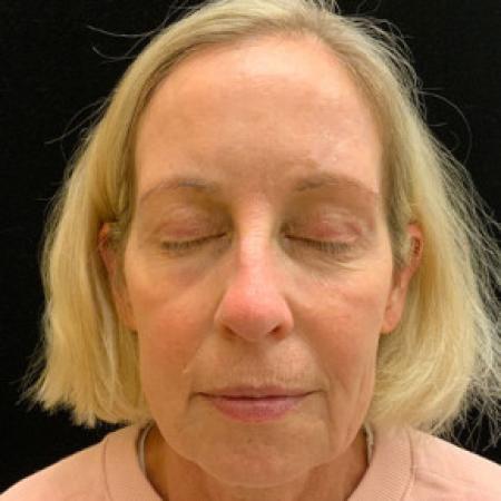 After image 3 Case #101566 - Blepharoplasty