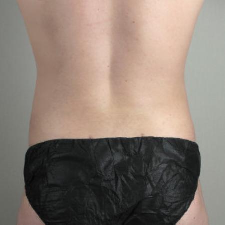 After image 3 Case #103131 - Liposuction of the Abdomen & Flanks Patient 70