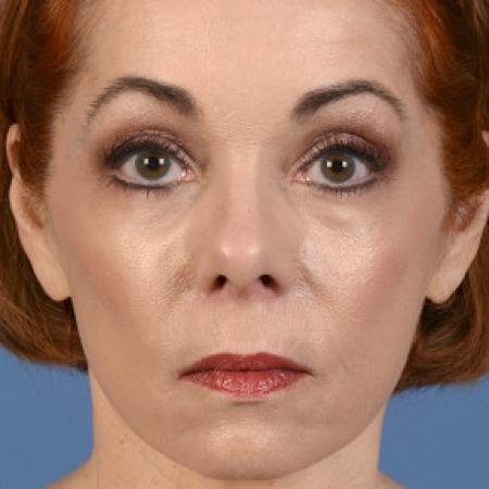 After image 1 Case #102136 - Facelift - 60-year-old woman