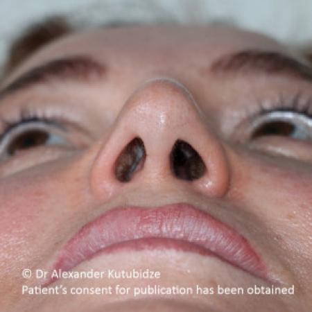 After image 6 Case #103366 - 8 years after aging aesthetic functional rhinoplasty secondary to previous teen age septoplasty 