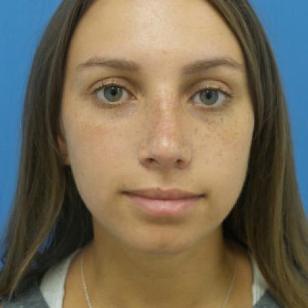 After image 1 Case #102191 - 22 year old  -  Rhinoplasty/Septoplasty/Turbinectomy  -  1 month post-op