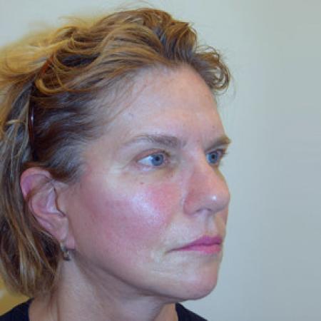 After image 4 Case #101576 - Facelift