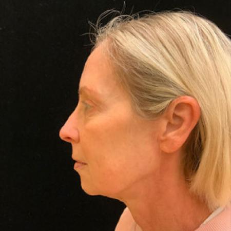 After image 4 Case #101566 - Blepharoplasty