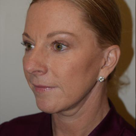 After image 3 Case #101546 - Facelift 