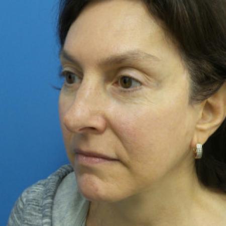 After image 2 Case #102181 - 58 year old  -  Browlift/Facelift/Lower Blepharoplasty/TCA Peel  -  10 months post-op