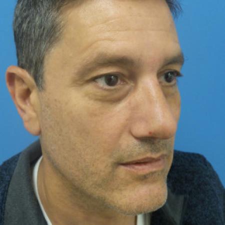 After image 2 Case #102161 - 54 year-old  -  Rhinoplasty/Septoplasty/Turbinectomy   4 weeks post-op