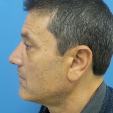 After image 3 Case #102161 - 54 year-old  -  Rhinoplasty/Septoplasty/Turbinectomy   4 weeks post-op