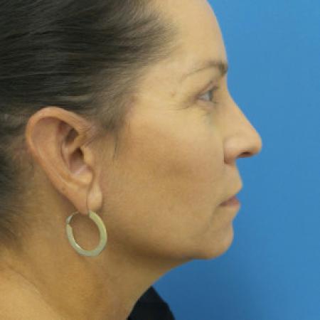 After image 3 Case #102166 - 53 year old  -  Facelift/Upper Blepharoplasty/TCA Peel to Lower lids/Otoplasty  -  2 months post-op