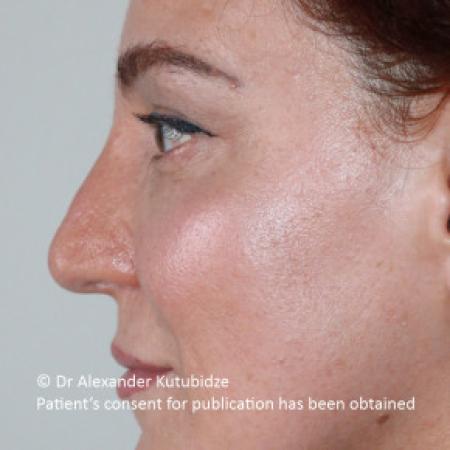 After image 4 Case #103366 - 8 years after aging aesthetic functional rhinoplasty secondary to previous teen age septoplasty 