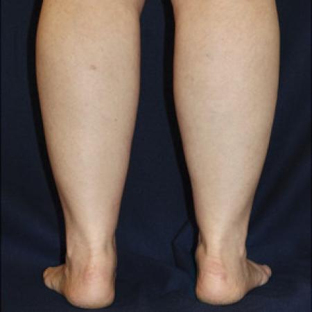 After image 3 Case #102686 - Lower Leg Liposuction