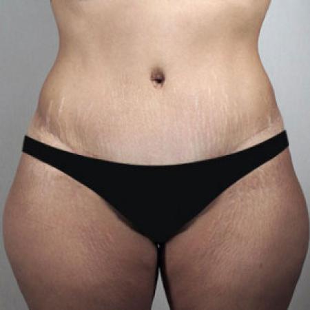 After image 1 Case #103161 - Tummy Tuck Patient 61