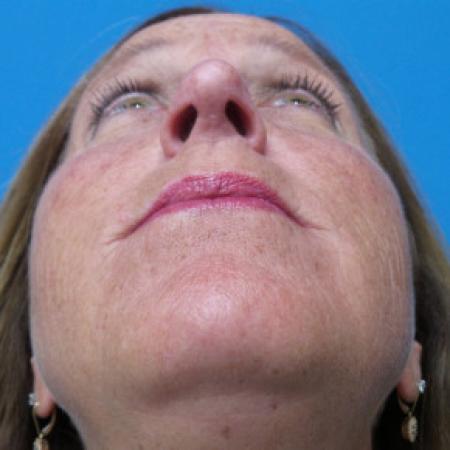 After image 4 Case #102276 - 55 year old - This patient presented with exposed bone after sustaining an open nasal bone fracture.