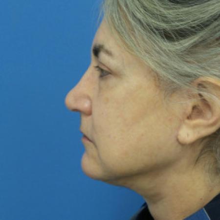 After image 3 Case #102216 - 66 year old   -  Facelift/Upper Blepharoplasty  -  3 1/2 months post-op