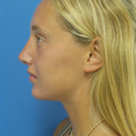 After image 3 Case #102301 - 17 year old  -  Open Septo-Rhinoplasty  -  3 months post-op