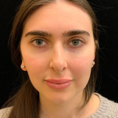 After image 3 Case #101571 - Rhinoplasty