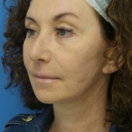 After image 2 Case #102266 - 55 year old  -  Facelift  -  2 months post-op