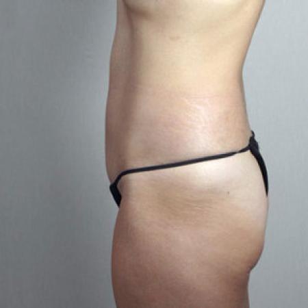 After image 2 Case #103166 - Mini Tummy Tuck Patient 20