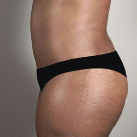 After image 2 Case #103171 - Tummy Tuck with Liposuction Patient 57