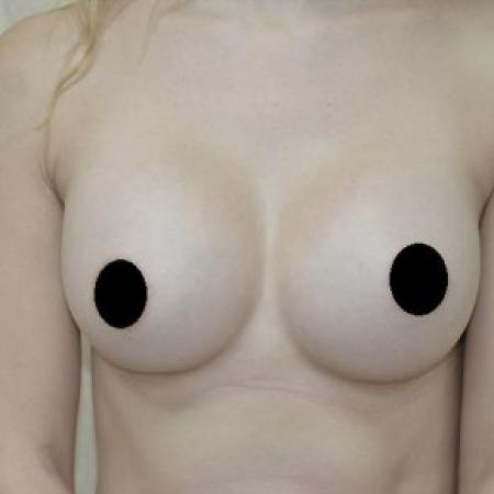 After image 1 Case #103121 - Breast Augmentation 