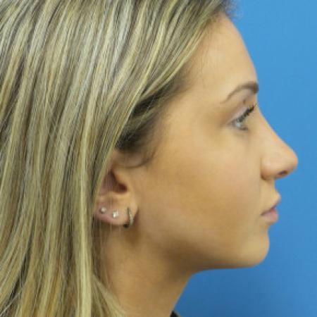 After image 3 Case #102171 - 18 year old - Open Rhinoplasty w/submucous resection/Septoplasty & Spreader grafts to improve airway 