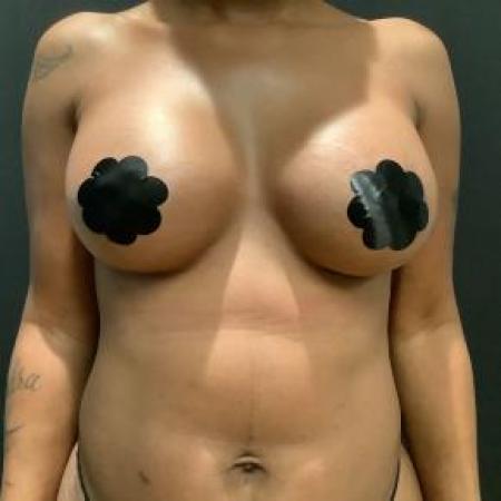 After image 1 Case #103346 - Breast Augmentation with 470 cc implants