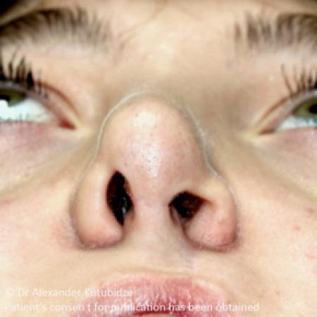 After image 4 Case #103356 - One year after repair of the unilateral cleft lip/nose deformity