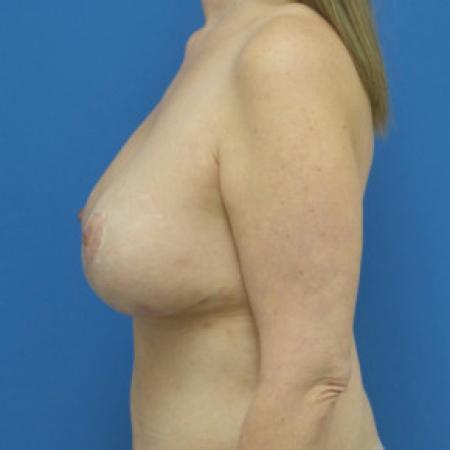 After image 3 Case #102226 - 41 year old  -  Bilateral Breast Augmentation with Lift/Subglandular – 320cc Smooth, Low+ Profile Silicone Gel implants -  2 1/2 months post-op