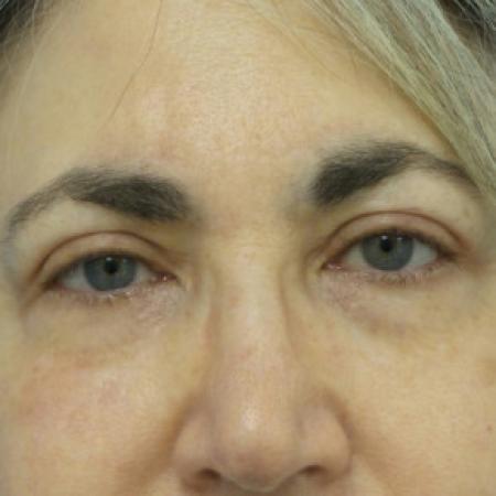 After image 1 Case #102221 - 66 year old   -  Upper Blepharoplasty/Facelift  -  3 1/2 months post-op