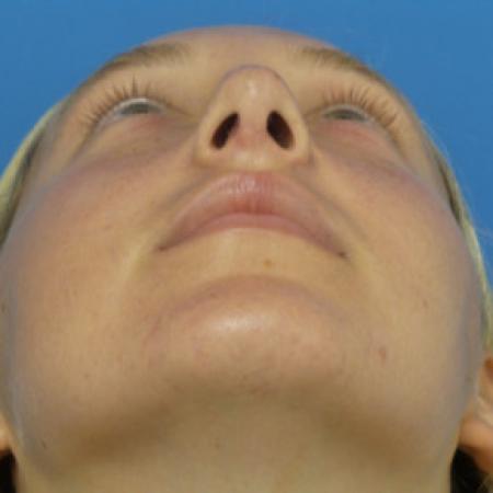 After image 4 Case #102301 - 17 year old  -  Open Septo-Rhinoplasty  -  3 months post-op