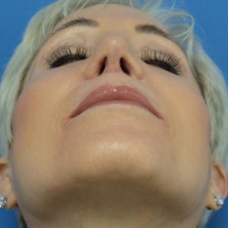 After image 4 Case #102246 - 65 year old  -  Open Secondary Rhinoplasty. Revision from another surgeon    1 month post-op