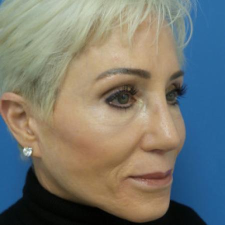 After image 2 Case #102246 - 65 year old  -  Open Secondary Rhinoplasty. Revision from another surgeon    1 month post-op