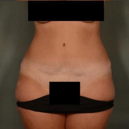 After image 1 Case #101591 - Abdominoplasty