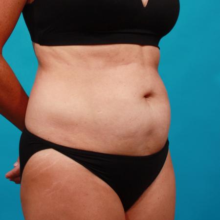 Before image 2 Case #104206 - Tummy Tuck