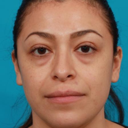Before image 1 Case #104336 - Blepharoplasty