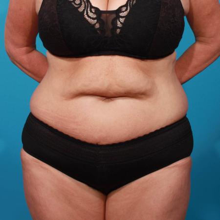 Before image 1 Case #103906 - Tummy Tuck with SAL