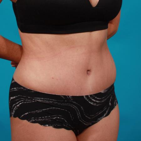 After image 2 Case #104206 - Tummy Tuck