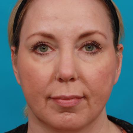 Before image 1 Case #104251 - Chin Augmentation
