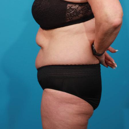 Before image 3 Case #103906 - Tummy Tuck with SAL
