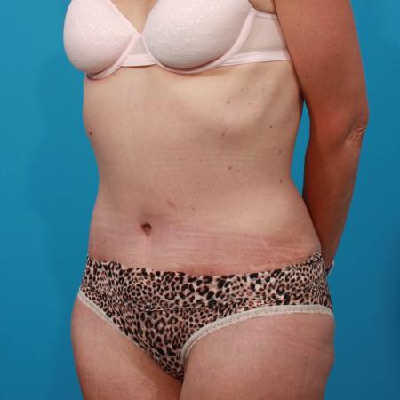 After image 2 Case #103846 - Tummy Tuck