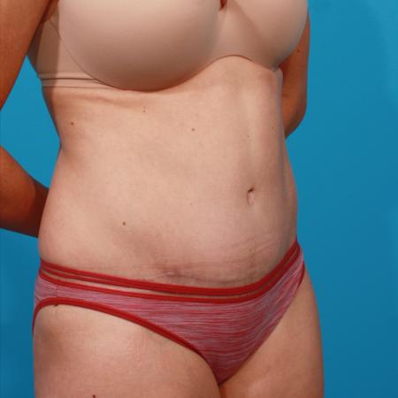 After image 2 Case #104186 - Tummy Tuck
