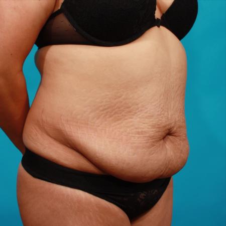 Before image 2 Case #104356 - Tummy Tuck