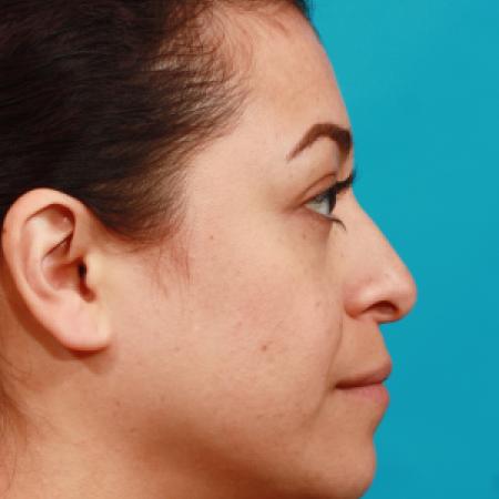 After image 3 Case #104336 - Blepharoplasty