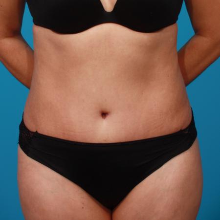 After image 1 Case #104331 - Tummy Tuck
