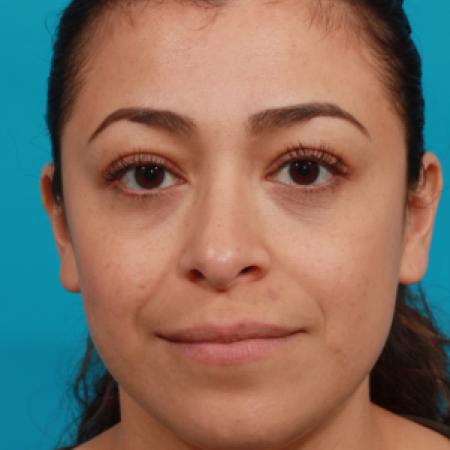 After image 1 Case #104336 - Blepharoplasty